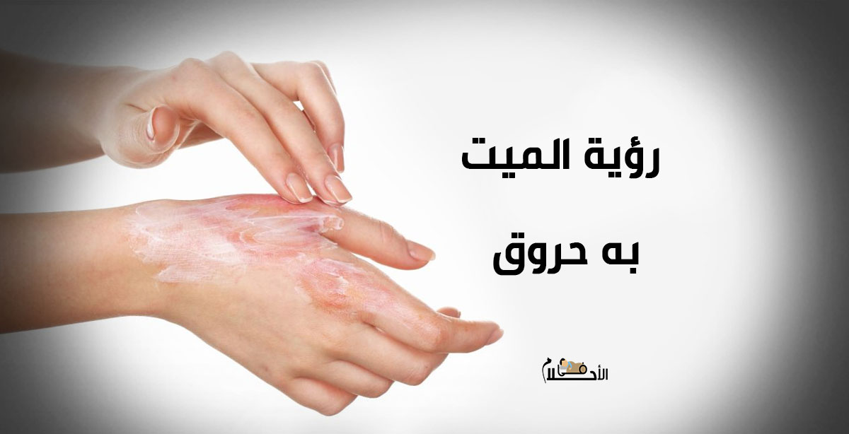 رؤية الميت به حروق