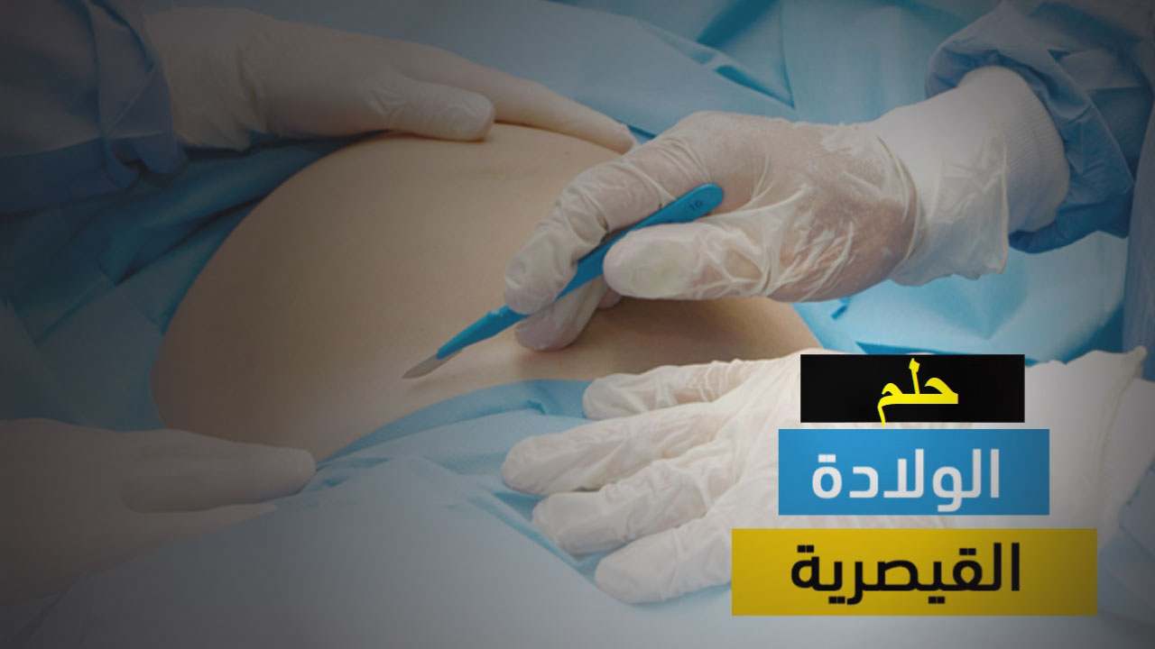 تفسير الولادة القيصرية في الحلم للمتزوجة الغير حامل