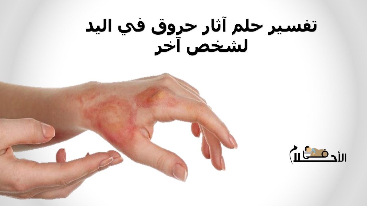تفسير حلم آثار حروق في اليد لشخص آخر