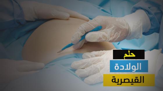 تفسير الولادة القيصرية في الحلم للمتزوجة الغير حامل