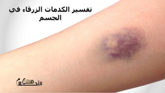 تفسير الكدمات الزرقاء في الجسم
