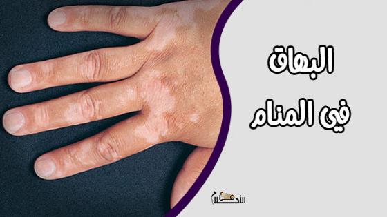 تفسير حلم البهاق