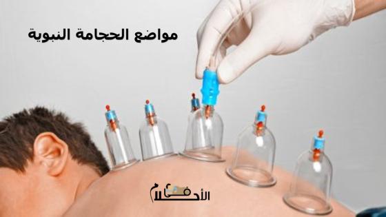 مواضع الحجامة النبوية